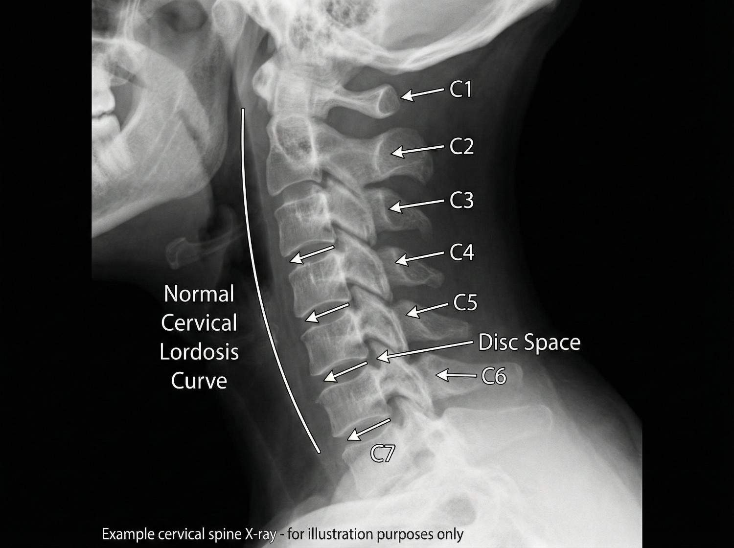 Understanding Whiplash: The Mechanism of Injury - illustration 1